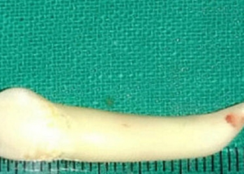 Indian dentist reportedly extracts world's longest tooth