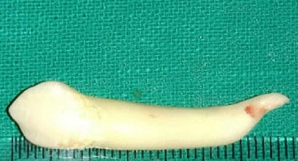 Indian dentist reportedly extracts world's longest tooth