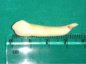 Indian dentist reportedly extracts world's longest tooth