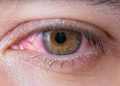 Macro of conjunctivitis red eye.