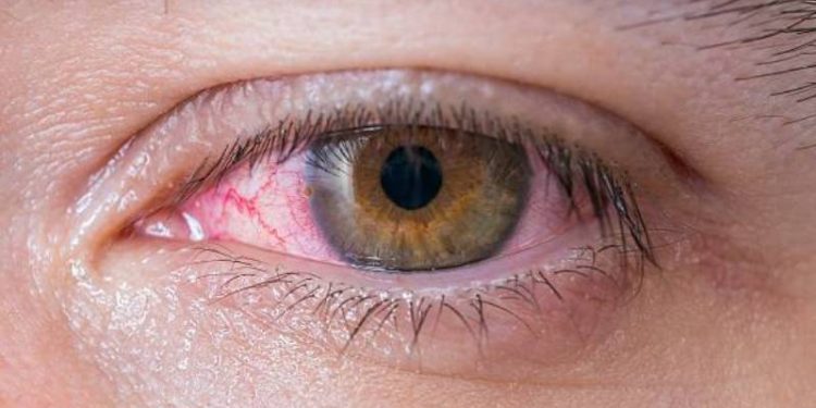 Macro of conjunctivitis red eye.