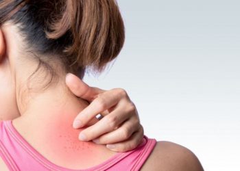 heat-rash