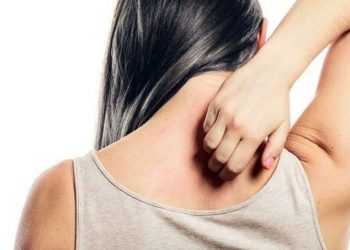 Mosquito bite women