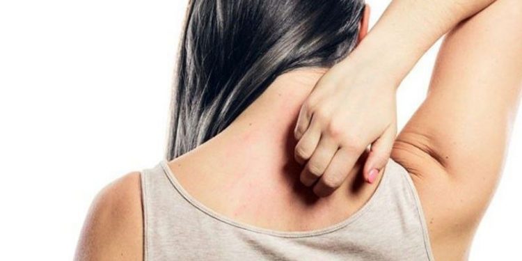 Mosquito bite women