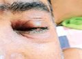 ক’ভিড আক্ৰান্তৰ শৰীৰত দেখা দিয়া ব্লেক ফাংগাছৰ সংক্ৰমণ : কি পৰামৰ্শ দিলে কেন্দ্ৰীয় স্বাস্থ্যমন্ত্ৰীয়ে?