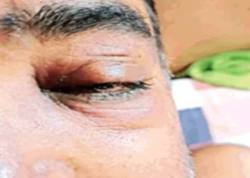 ক’ভিড আক্ৰান্তৰ শৰীৰত দেখা দিয়া ব্লেক ফাংগাছৰ সংক্ৰমণ : কি পৰামৰ্শ দিলে কেন্দ্ৰীয় স্বাস্থ্যমন্ত্ৰীয়ে?