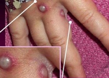 monkeypox uk