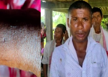 snake bite