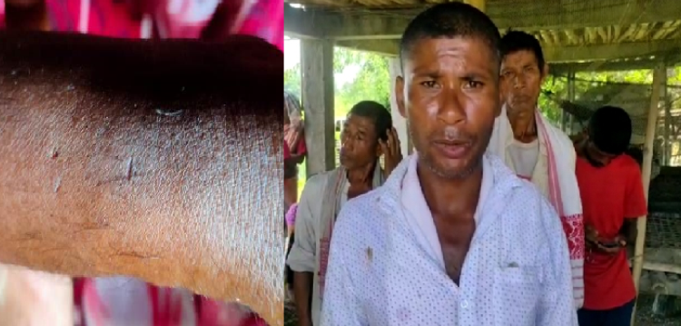 snake bite