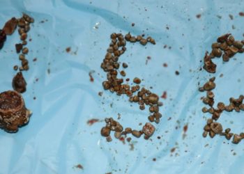 Kidney stone