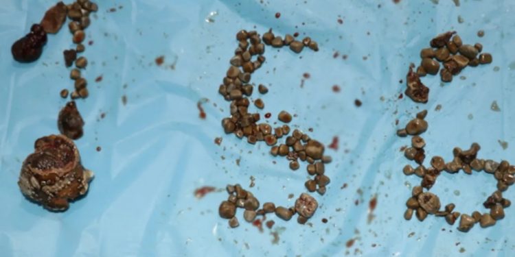 Kidney stone