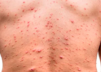 Monkeypox: টমেট’ ফ্লুৰ মাজতে মাঙ্কিপক্সৰ আতংক; কিমান প্ৰস্তুত ভাৰত?