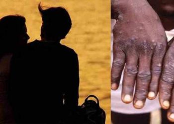 Monkeypox: যৌন সম্পৰ্কৰেও বিয়পিব পাৰে মাঙ্কিপক্স; বিশেষজ্ঞসকলে কৰিলে সতৰ্ক