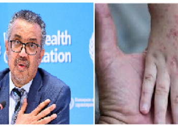 WHO on Monkeypox