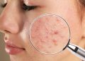 TIPS FOR MANAGING ACNE
