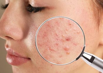 TIPS FOR MANAGING ACNE