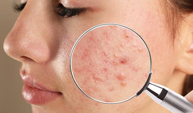 TIPS FOR MANAGING ACNE