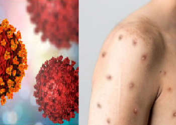 Covid-Monkeypox: একেলগে দুটা ভাইৰাছৰ সংক্ৰমণ! প্ৰথমবাৰ কৰ’না আৰু মাঙ্কিপক্সৰ দ্বাৰা আক্ৰান্ত হ’ল এক ব্যক্তি