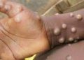 Monkeypox in India: ভাৰততো ধৰা পৰিল মাঙ্কিপক্স; কেৰালাত প্ৰথমটো আক্ৰান্তৰ ঘটনা পোহৰলৈ