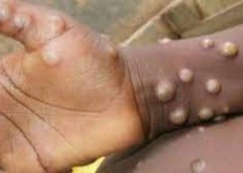 Monkeypox in India: ভাৰততো ধৰা পৰিল মাঙ্কিপক্স; কেৰালাত প্ৰথমটো আক্ৰান্তৰ ঘটনা পোহৰলৈ