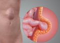 Hernia হাৰ্নিয়া কি আৰু ই কেনেকৈ হয়, কাৰণ সমূহ জানেনে?