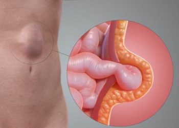 Hernia হাৰ্নিয়া কি আৰু ই কেনেকৈ হয়, কাৰণ সমূহ জানেনে?
