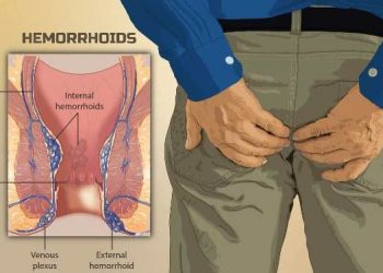 Hemorrhoids or Piles: অৰ্শৰোগ কি জানেনে? জানো আহক কেনেকৈ ইয়াৰ চিনাক্তকৰণ হয়