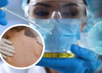 India records first Monkeypox death: দেশত মাঙ্কিপক্সত প্ৰথম মৃত্যু! বিদেশৰ পৰা উভতি অহাৰ পিছতেই মৃত্যু কেৰালাৰ যুৱকৰ