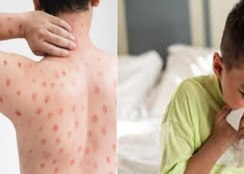 Tomato Flu Outbreak in India: ভাৰতত বৃদ্ধি পাইছে টমেট’ ফ্লু; ৮২ জনৰ শৰীৰত হৈছে চিনাক্ত, জানক সৱিশেষ