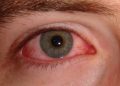 Eye disease