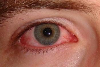 Eye disease