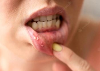 Mouth ulcers or Stomatitis: মুখগহ্বৰৰ ঘাঁ বা মুখপাক ৰোগৰ কথা জানেনে? আহকচোন ইয়াৰ চিকিৎসা সম্পৰ্কে কিছু কথা জানো