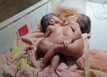 প্ৰকৃতিৰ লীলাঃ ৰাজস্থানত দুটা দেহ একেলগে লগ লাগি থকা যমজ সন্তানৰ জন্ম