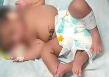 চাৰিখন ভৰিৰে জন্ম হ’ল নৱজাতকৰ; লাখ লাখ শিশুৰ ভিতৰত মাত্ৰ এজনহে আক্ৰান্ত হয় এই বিৰল ৰোগত