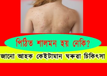 পিঠিত শালমন হয় নেকি? জানো আহক কেইটামান ঘৰুৱা চিকিৎসা
