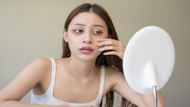 dark circles