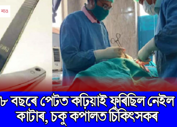 ৮ বছৰে পেটত কঢ়িয়াই ফুৰিছিল নেইল কাটাৰ, চকু কপালত চিকিৎসকৰ