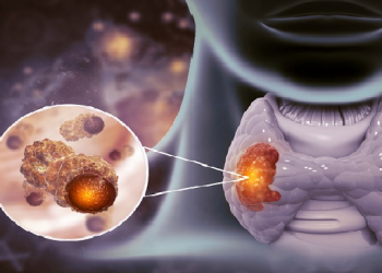 Thyroid cancer