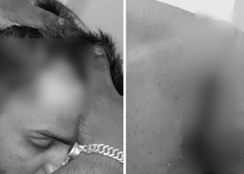 কৰিমগঞ্জত যুৱ কংগ্ৰেছৰ কৰ্মীক চোকা অস্ত্ৰৰে আক্ৰমণ এ বি ভি পি সদস্যৰ