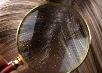 Dandruff