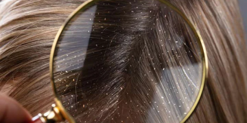 Dandruff