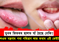 মুখৰ ভিতৰৰ ছালত ঘাঁ হৈছে নেকি? জানি লওক যন্ত্ৰণাৰ পৰা পৰিত্ৰাণ লাভ কৰাৰ এই কেইটা দিহা
