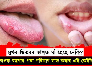 মুখৰ ভিতৰৰ ছালত ঘাঁ হৈছে নেকি? জানি লওক যন্ত্ৰণাৰ পৰা পৰিত্ৰাণ লাভ কৰাৰ এই কেইটা দিহা
