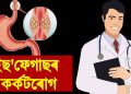 ইছ’ফেগাছৰ কৰ্কটৰোগ : কেন্সাৰ ৰোগ বিশেষজ্ঞ ডাঃ বিক্ৰম কুমাৰ ডেকাৰ এটি বিশেষ প্ৰৱন্ধ