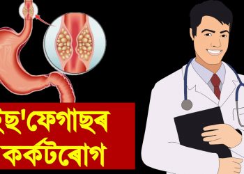 ইছ’ফেগাছৰ কৰ্কটৰোগ : কেন্সাৰ ৰোগ বিশেষজ্ঞ ডাঃ বিক্ৰম কুমাৰ ডেকাৰ এটি বিশেষ প্ৰৱন্ধ