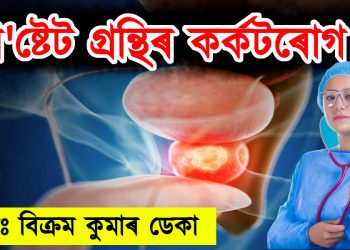প্ৰ’ষ্টেট গ্ৰন্থিৰ কৰ্কটৰোগ