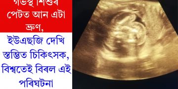 গৰ্ভস্থ শিশুৰ পেটত আন এটা ভ্ৰুণ, ইউএছজি দেখি স্তম্ভিত চিকিৎসক, বিশ্বতেই বিৰল এই পৰিঘটনা