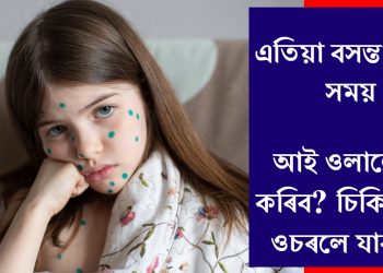 এতিয়া বসন্ত ৰোগৰ সময় : আই ওলালে কি কৰিব? চিকিৎসকৰ ওচৰলে যাবনে?
