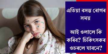 এতিয়া বসন্ত ৰোগৰ সময় : আই ওলালে কি কৰিব? চিকিৎসকৰ ওচৰলে যাবনে?