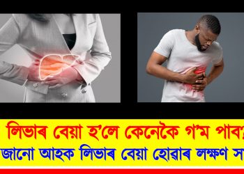 লিভাৰ বেয়া হ’লে কেনেকৈ গ’ম পাব? জানো আহক লিভাৰ বেয়া হোৱাৰ লক্ষণ সমূহ